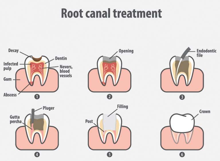 Root Canals - Family Dentistry of Taylor - Richard A. Ray DDS